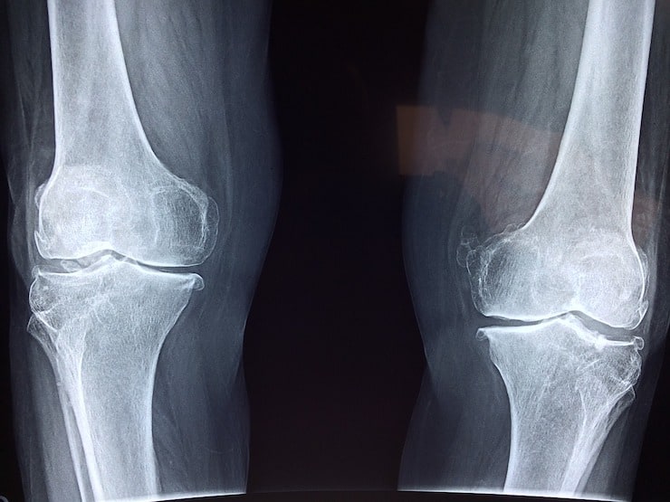 black and white X-ray of knees